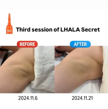 LHALA Peel cosmetic outcome image 3