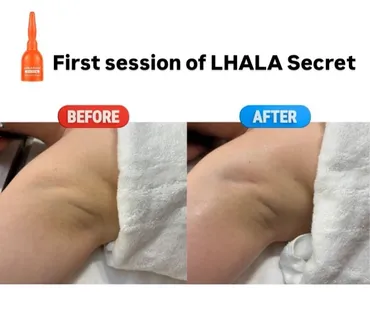 LHALA Peel cosmetic outcome image 4