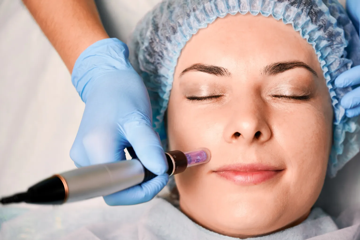 Microdermabrasion Treatment