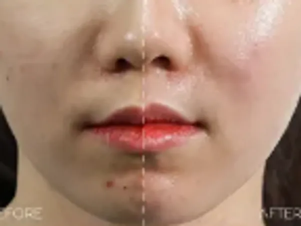 LHALA peel acne treatment result information