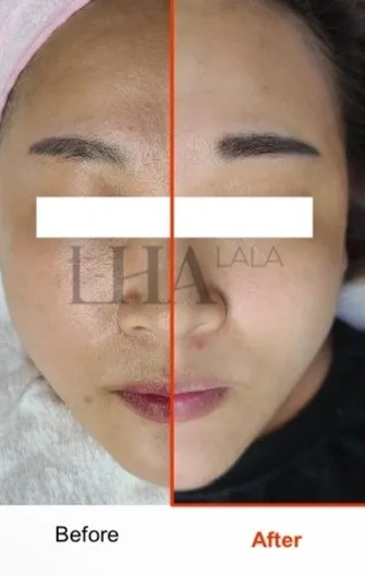 LHALA peel treatment visual 3